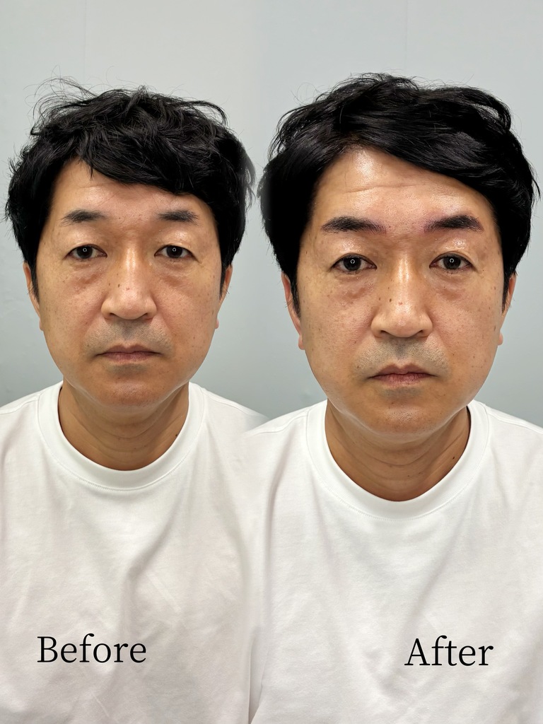 50代男性のナノヘアストローク眉の施術前後症例