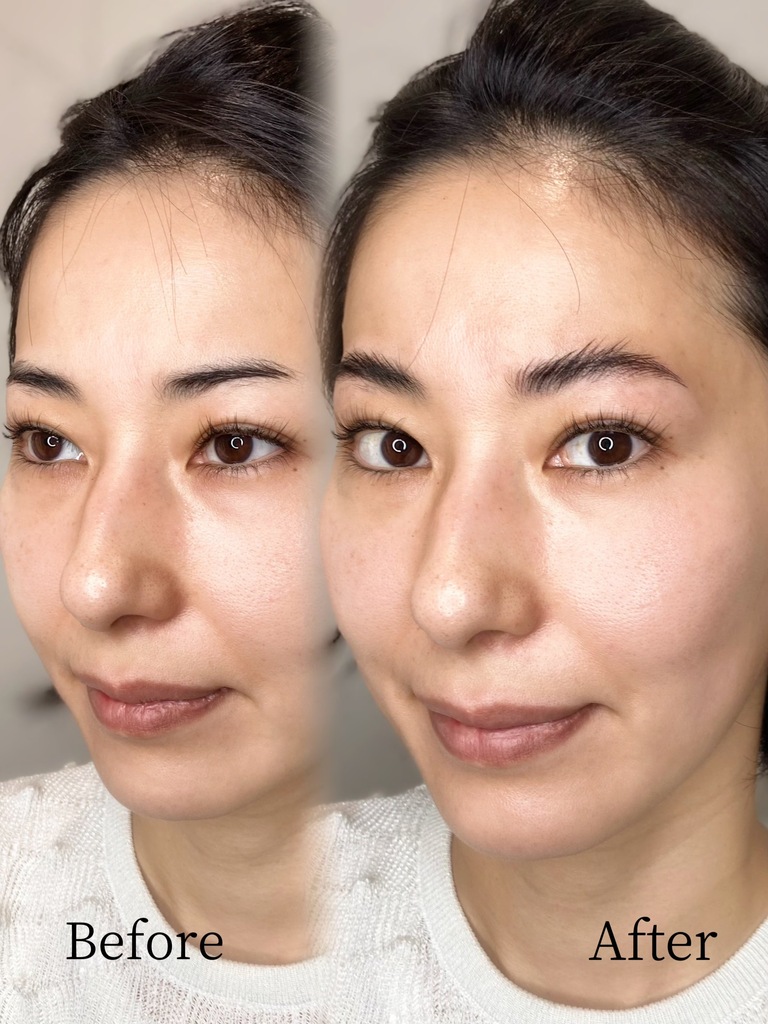 40代女性の眉尻を補ったナノヘアストローク症例