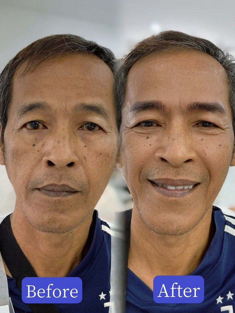 50代男性の下り眉を整えたナノヘアストローク症例