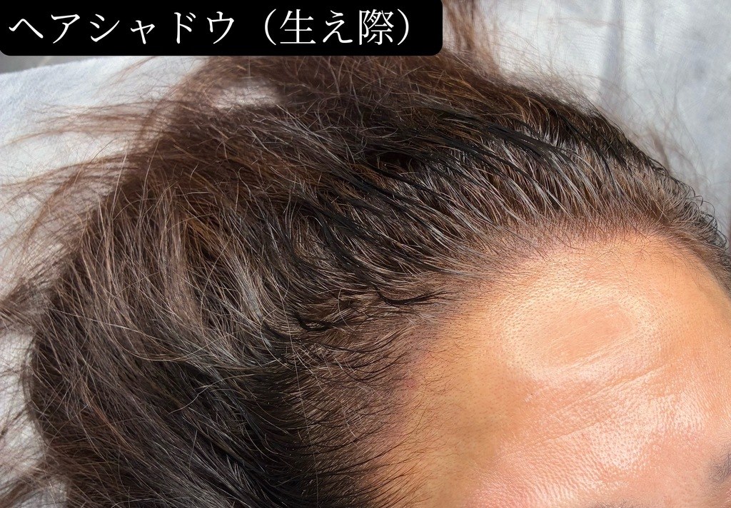 60代女性の生え際をカバーしたヘアシャドウ症例